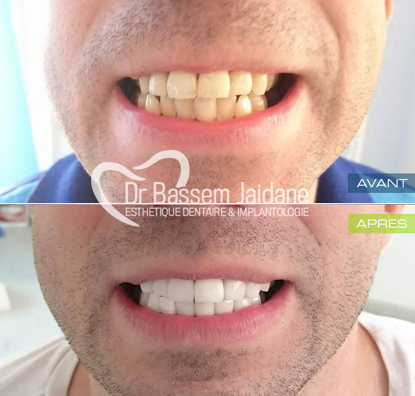 photos facettes dentaires tunisie   dr bassem jaidane