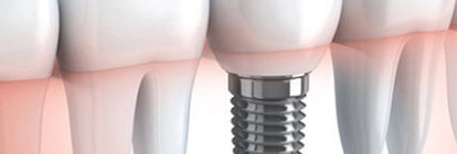 prix implants dentaires Tunisie