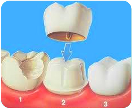Couronne dentaire