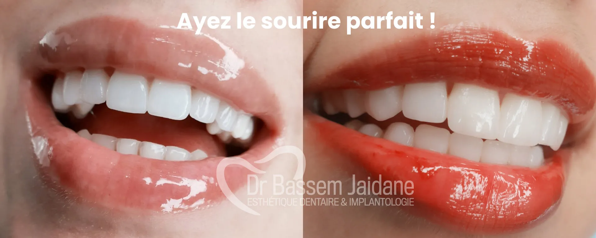 Facettes dentaires Tunisie