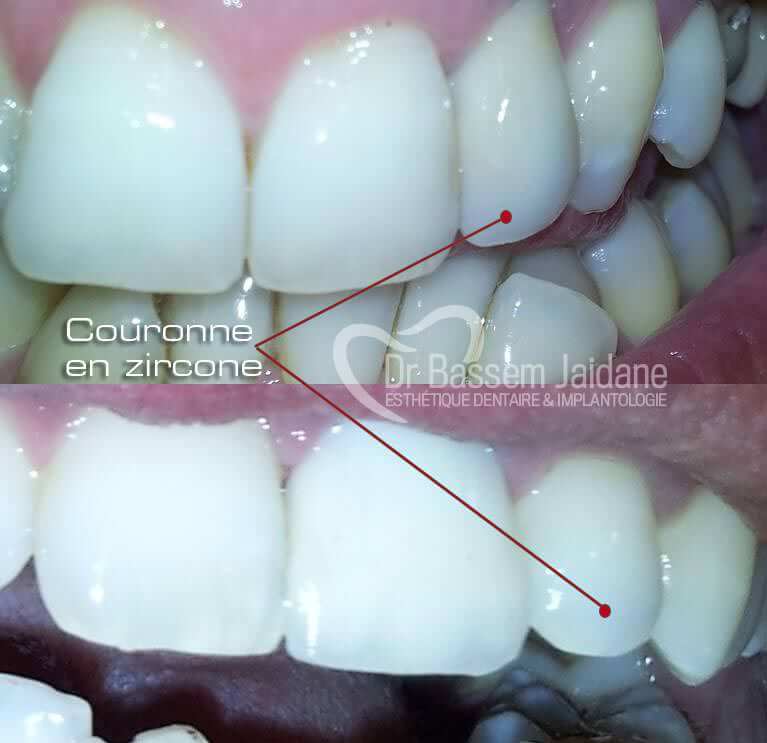 photos couronnes dentaires tunisie   dr bassem jaidane