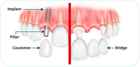 Implant dentaire