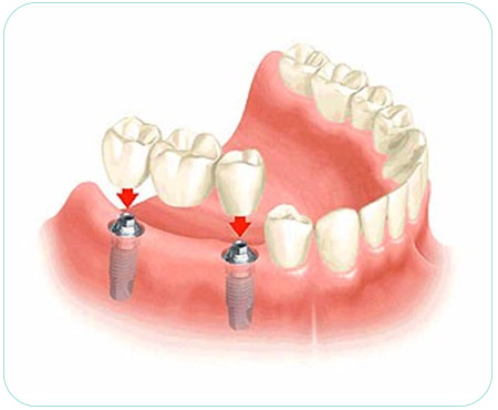 Implant dentaire