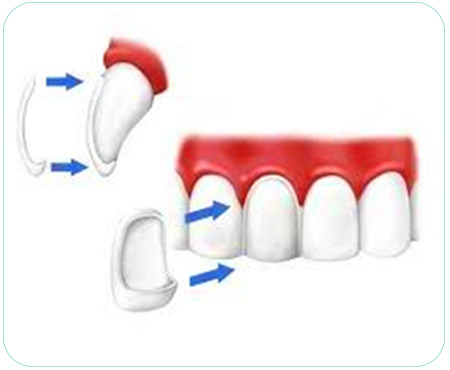 facette dentaire veneers