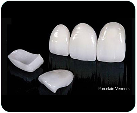 facette dentaire veneers